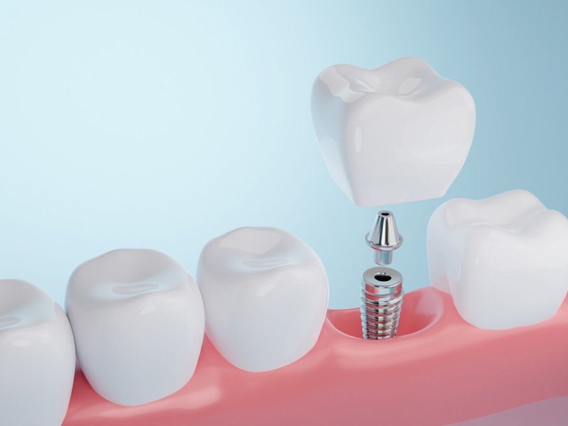 Precios de implantes dentales en Málaga