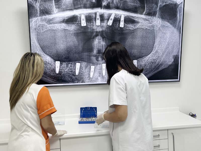 Precios de implantes dentales en Málaga según el tratamiento
