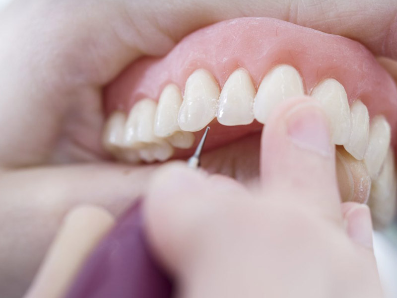 Ventajas de las prótesis dentales