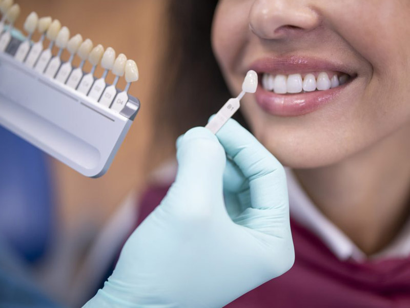 Recomendaciones de blanqueamiento dental para elegir el tipo de tratamiento