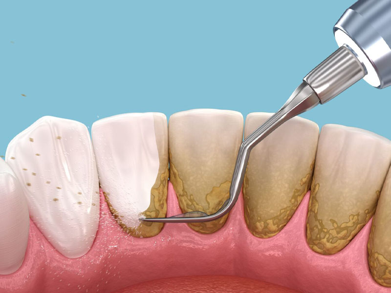 Qué es una limpieza dental profundo